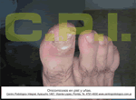 Hongos en pies onicomicosis Podologia Uba Zona Norte Martinez Buenos Aires Argentina