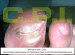 Hongos en las uñas de los pies Onicomicosis tratamiento Zona Norte Podologia Uba Martinez