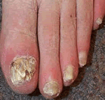 hongos-en-los-pies-Onicomicosis